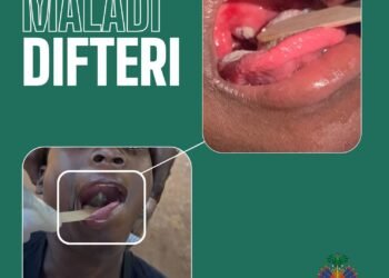 Diphtheria: MSPP launches a nationwide vaccination campaign across all ten departments