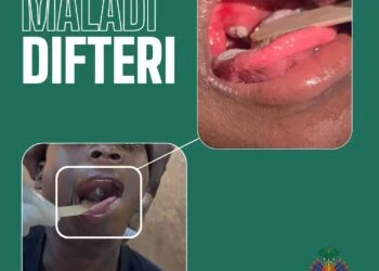Diphtheria: MSPP launches a nationwide vaccination campaign across all ten departments