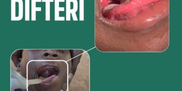 Diphtheria: MSPP launches a nationwide vaccination campaign across all ten departments