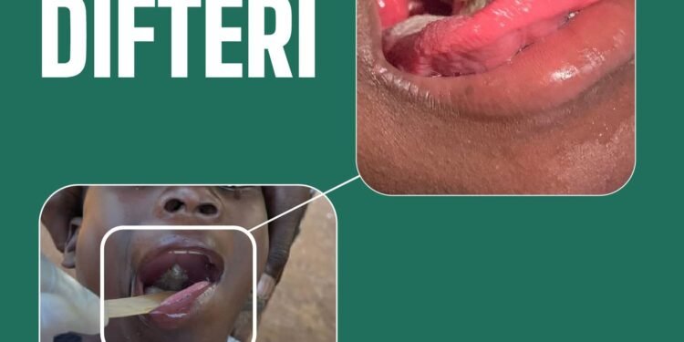 Diphtheria: MSPP launches a nationwide vaccination campaign across all ten departments